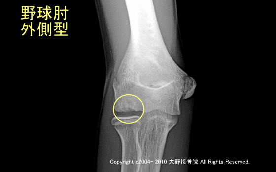外側型野球肘、上腕骨小頭離断性骨軟骨炎の選手のレントゲン画像