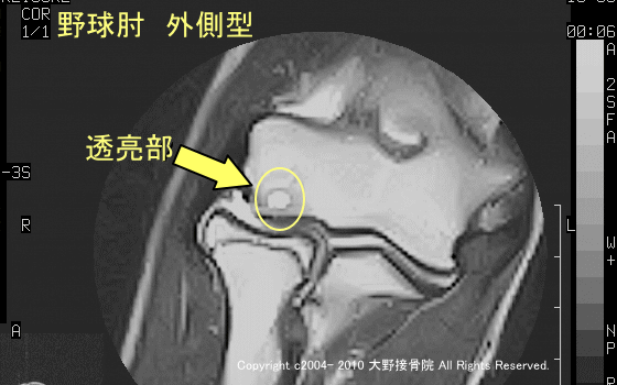 「上腕骨小頭離断性骨軟骨炎」透亮期の野球選手のMRI画像